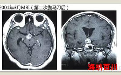 颅咽管瘤最新章节目录-颅咽管瘤小说,小说网,最新热门小说